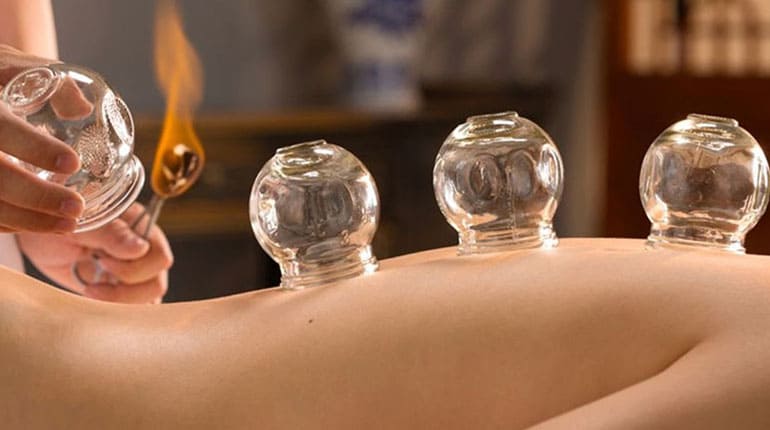 Acupuncture Cupping treatment